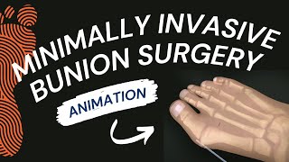 Minimally Invasive Bunion Surgery A Short Animation [upl. by Ahsienom]