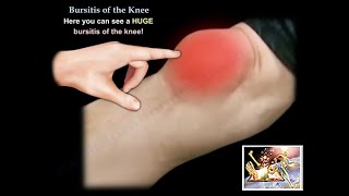 Knee Bursitis  Everything You Need To Know  Dr Nabil Ebraheim [upl. by Hudson172]