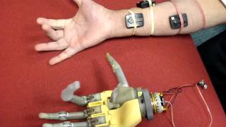 Prosthetic hand controlled by EMG 1 [upl. by Latty274]