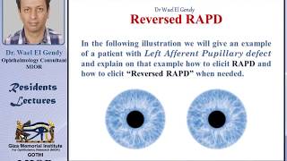 Reversed RAPD explained [upl. by Maddie401]