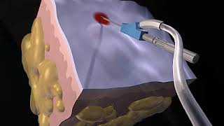 How Liposuction Works Animation  Liposuction Procedure Video [upl. by Eahsed585]