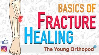 Fracture Healing  ANIMATION  BASICS  The Young Orthopod [upl. by Ayrb87]