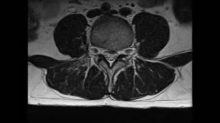 MRI of lumbar spine L4 L5 S1 disc bulge [upl. by Nguyen]