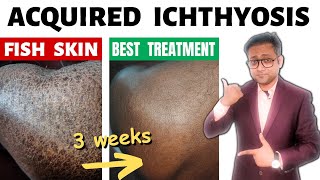 Acquired ichthyosis  Fish skin  Treatment  Hindi [upl. by Franny]