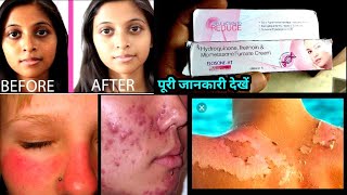 ELOSONE HT SKIN CREAM KAISE USE KARE  Elosone ht skin cream ke fayde in hindi [upl. by Aicad]