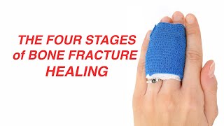 The Four Stages of Bone Fracture Healing [upl. by Adnic]