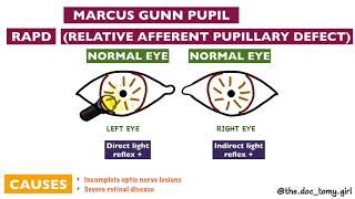 Abnormal Pupillary Reflexes  Ophthalmology [upl. by Smitt617]