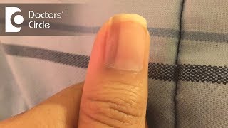 What causes vertical black lines on fingernails  Dr Aruna Prasad [upl. by Eillek]