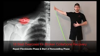 How to Treat a Broken Collar Bone [upl. by Niledam48]