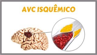 Acidente Vascular Cerebral Isquêmico  AVCI [upl. by Burck]