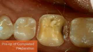 Immediate Dentin Sealing Technique [upl. by Reifinnej]