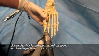 Bunion Surgery Video Saw Bones Dr Blitz [upl. by Holmes394]