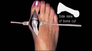 Austin bunionectomy with Akin osteotomy Moderate bunion correction surgery [upl. by Bogart]