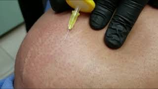 Carboxiterapia para estrias y celulitis [upl. by Masry661]