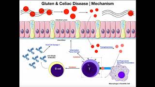 Understanding Celiac Disease Causes Symptoms and Treatment [upl. by Attennhoj]