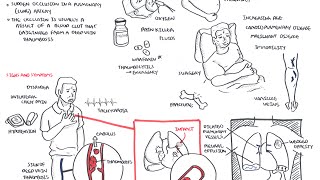 Pulmonary Embolism  Overview [upl. by Ecirb903]