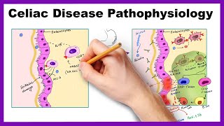 Understanding Coeliac Disease [upl. by Child]