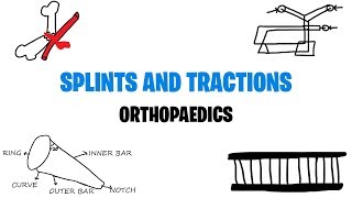 Principles of Fracture Fixation  Orthopedic Basics [upl. by Ahsiam]